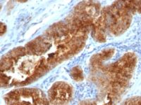 FFPE human prostate carcinoma sections stained with 100 ul anti-TAG-72 / CA72.4 (clone B72.3 + CC49) at 1:400. HIER epitope retrieval prior to staining was performed in 10mM Citrate, pH 6.0.